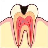 虫歯治療の実際