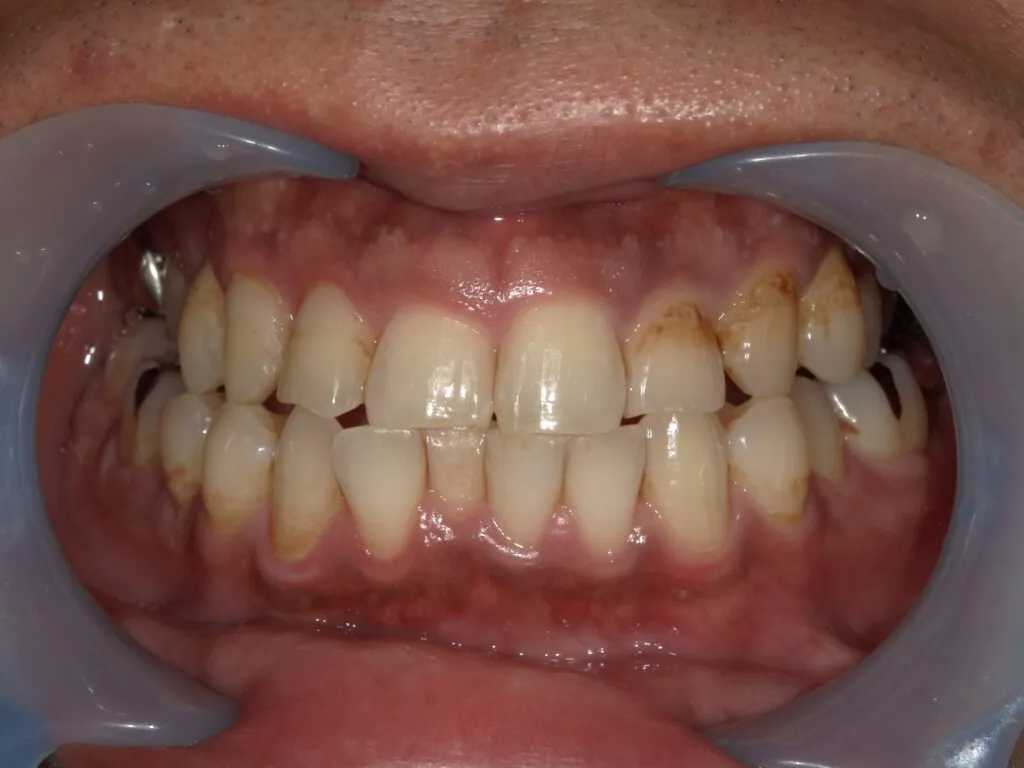 部分的に茶色い歯はホワイトニングで治る？