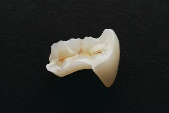 歯のセラミック