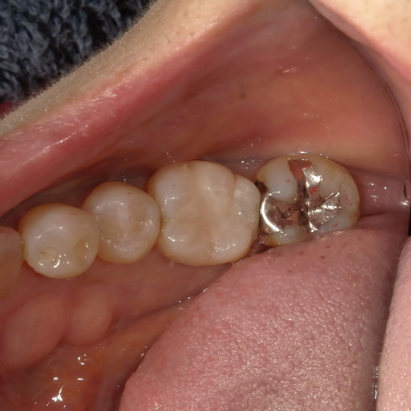 銀歯の下の虫歯