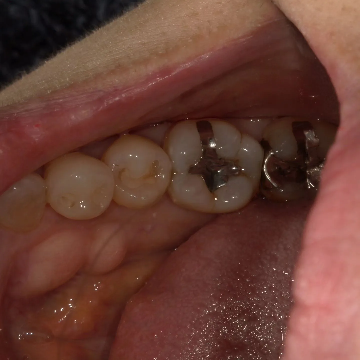 銀歯の下の虫歯