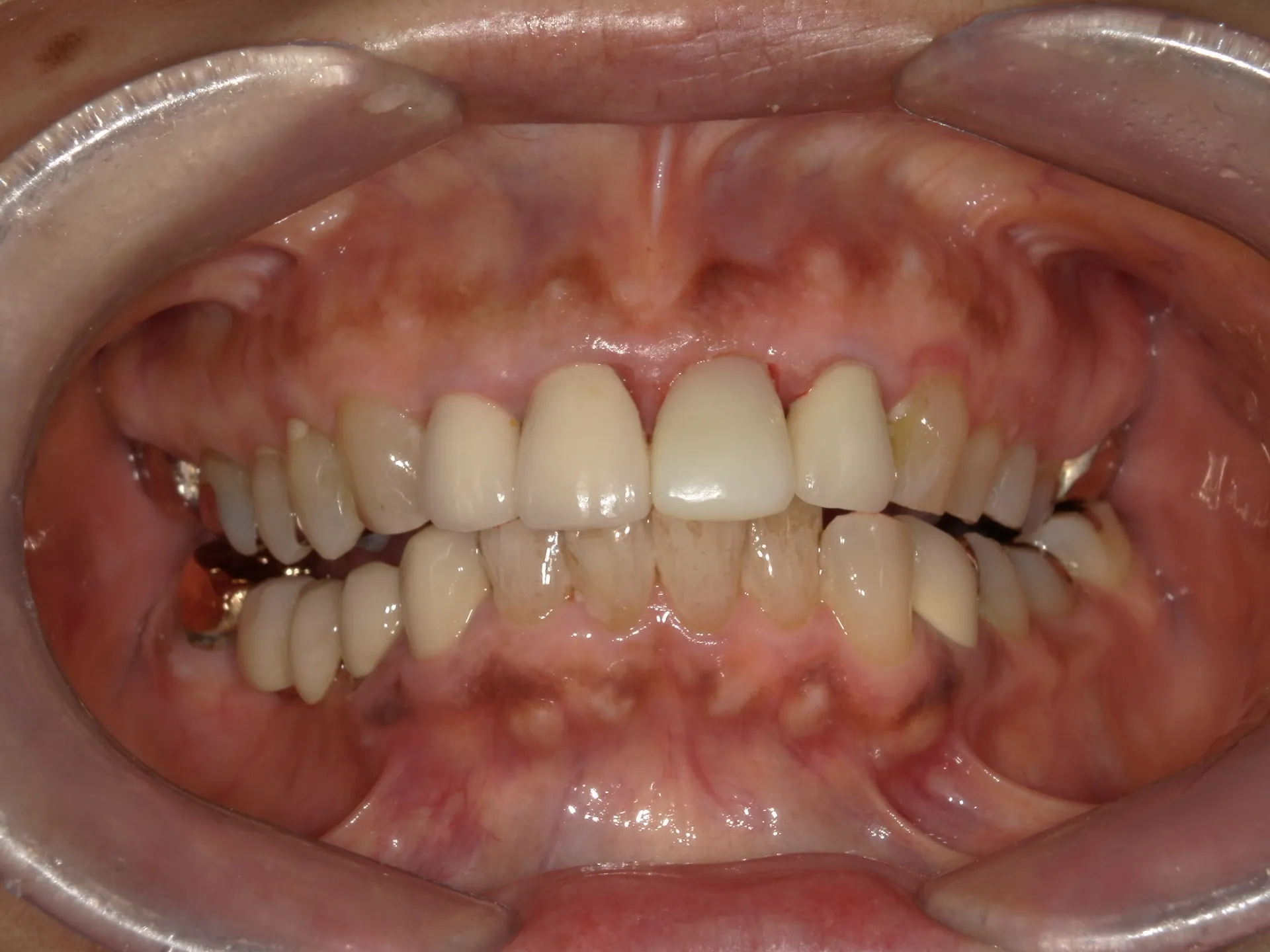 被せ物の歯