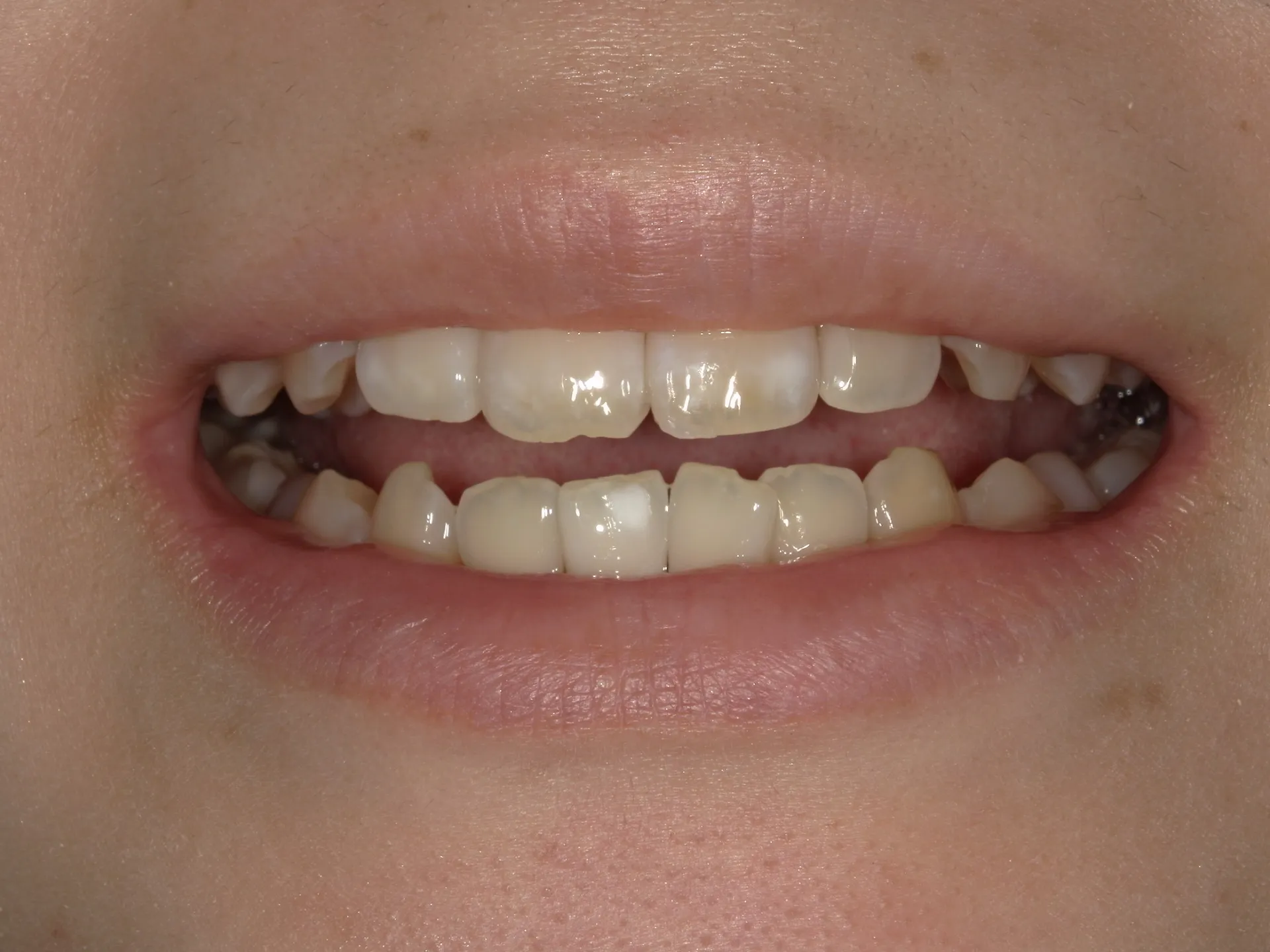 歯の一部が白いホワイトスポット