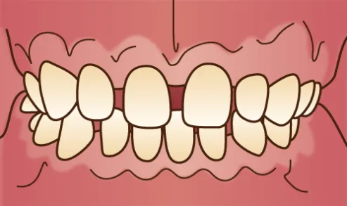 歯並びの改善方法は矯正だけじゃない！？