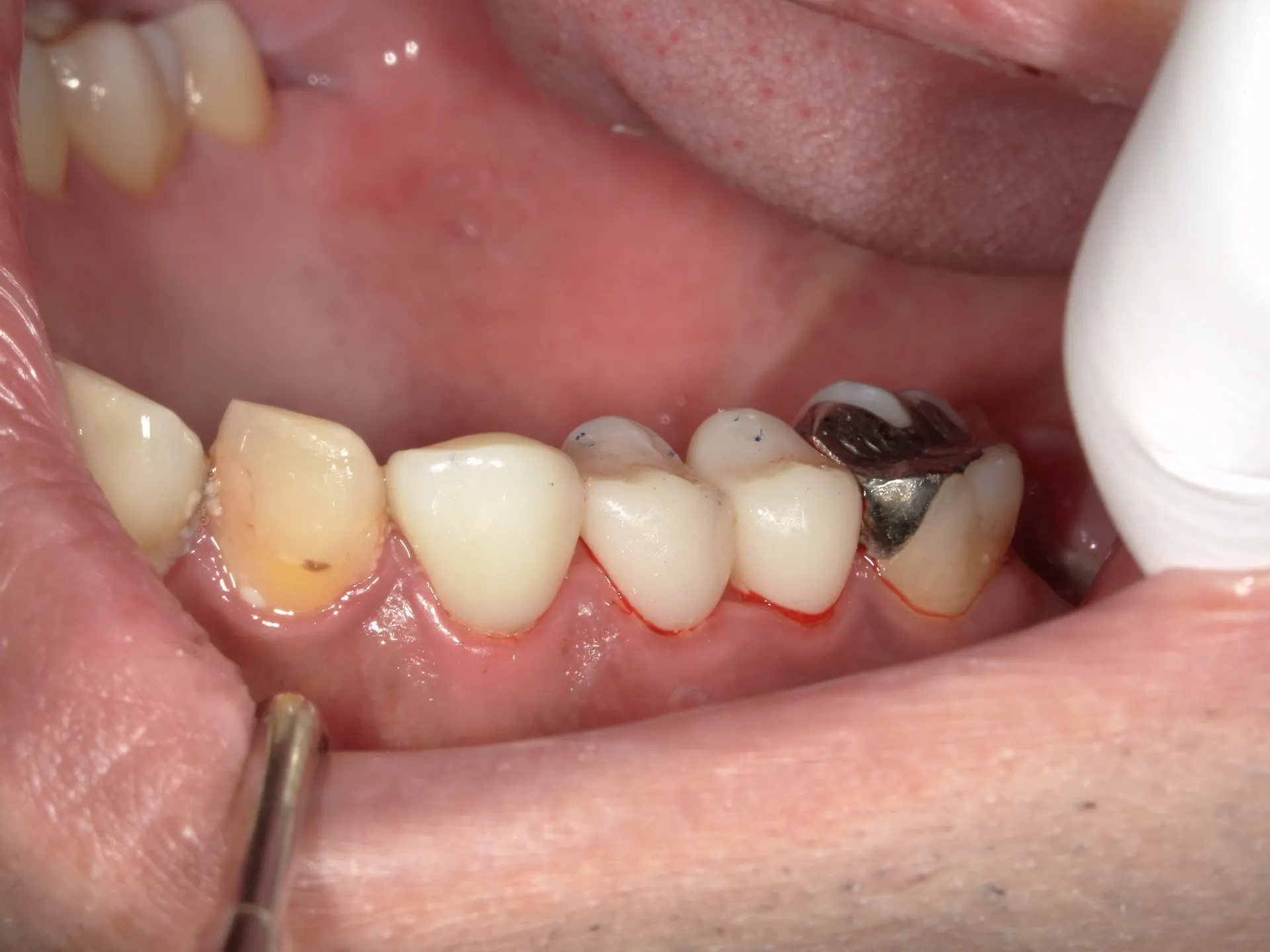 歯医者で最近流行りのCAD/CAM冠！