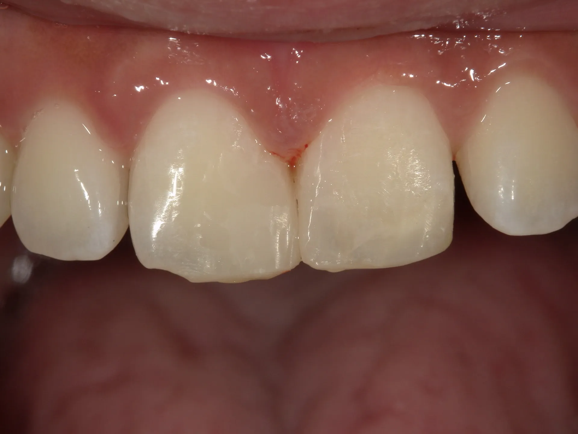 歯の隙間