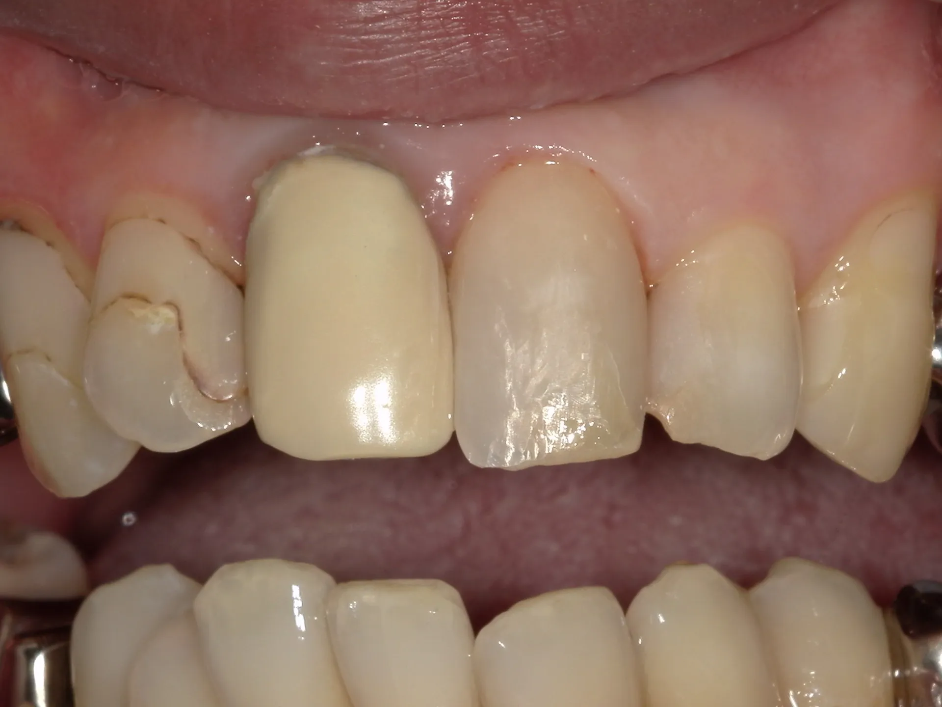 前歯の修正