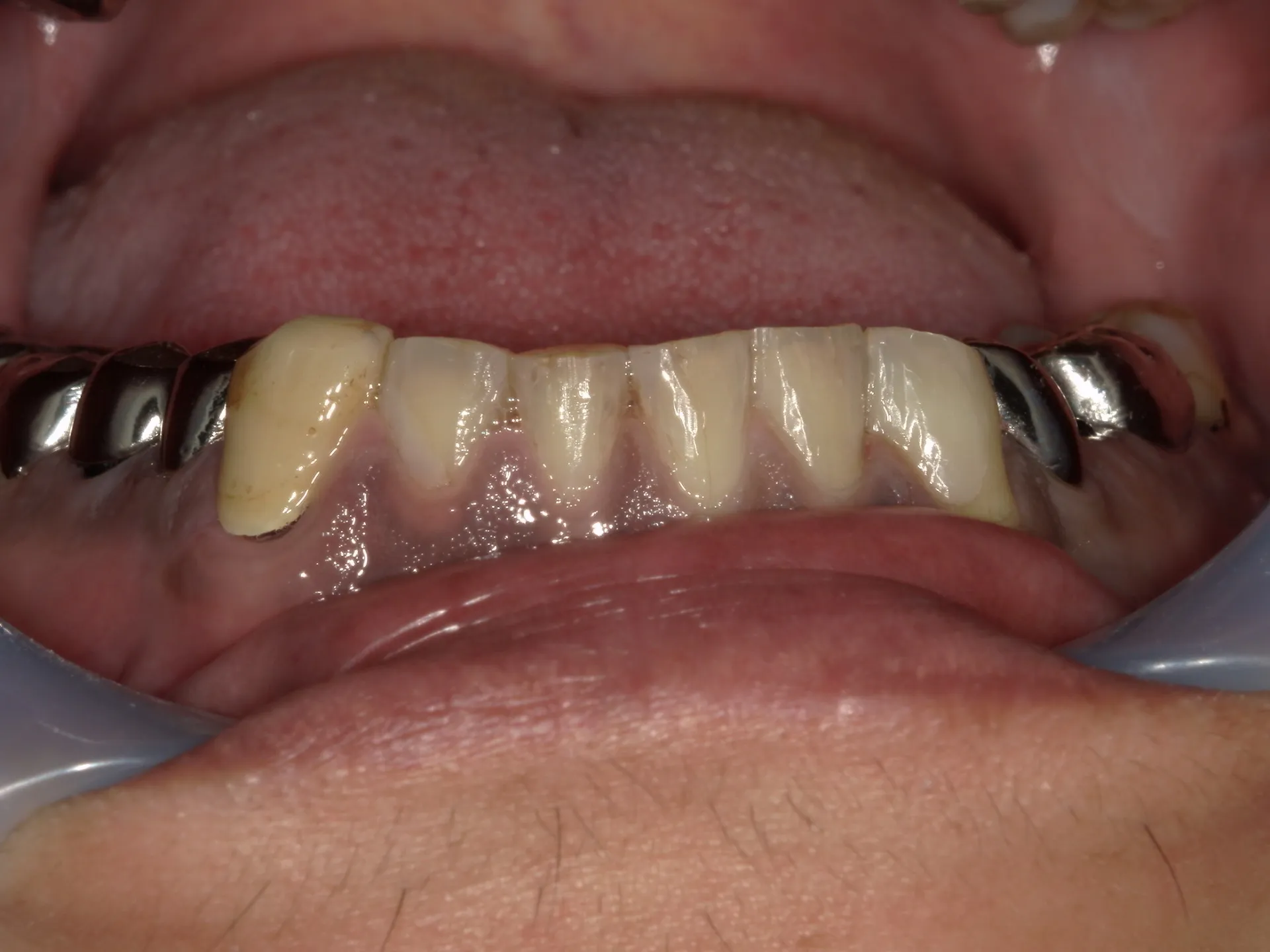 黒い下の前歯