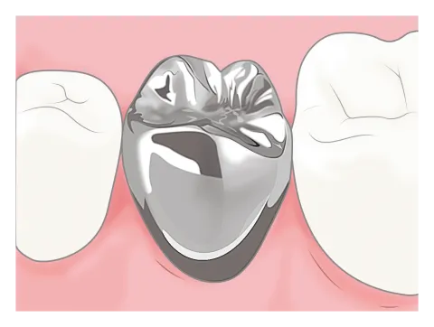 銀歯の中はどうなってる？