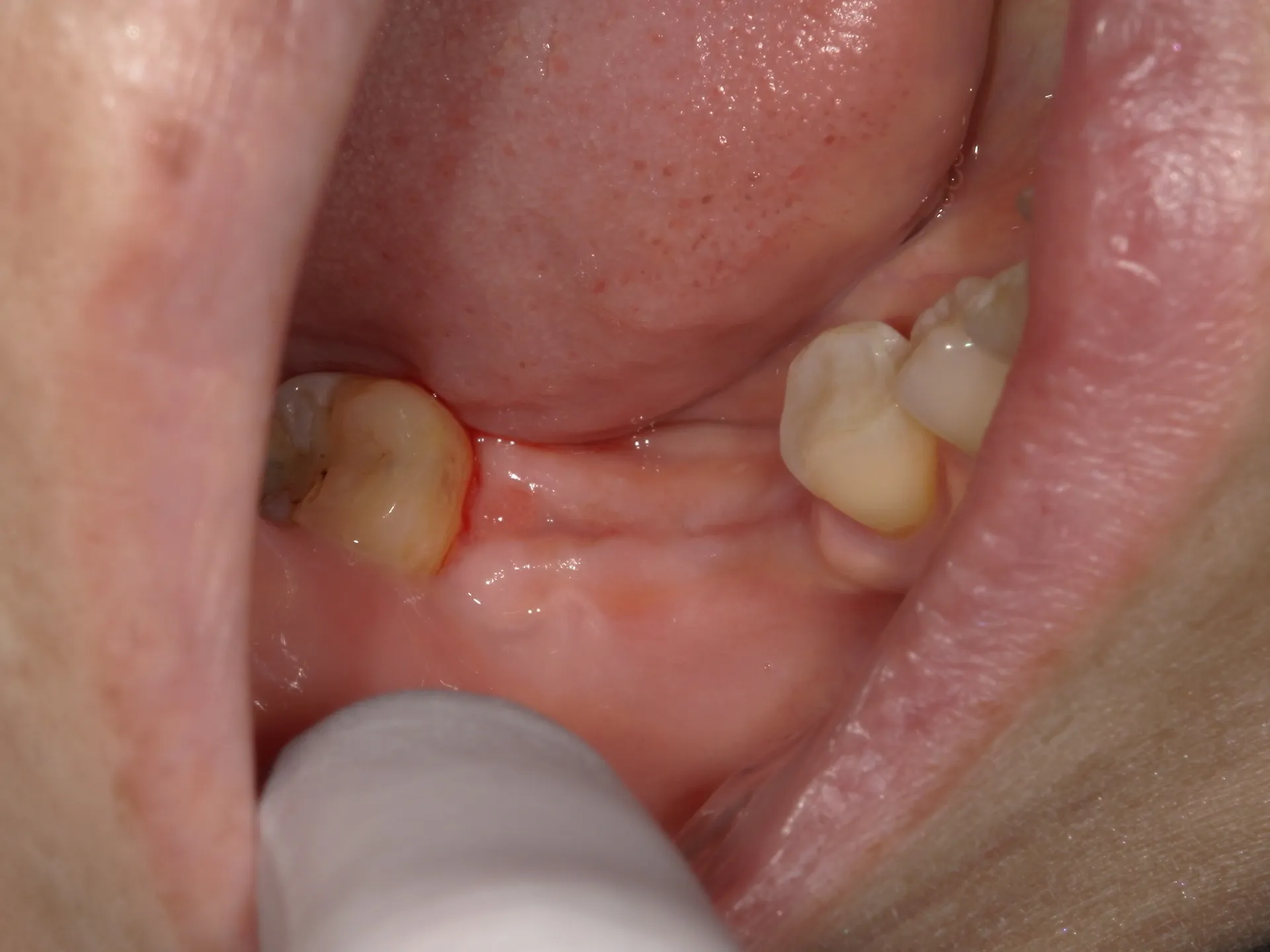 抜歯直後に入れる即時義歯