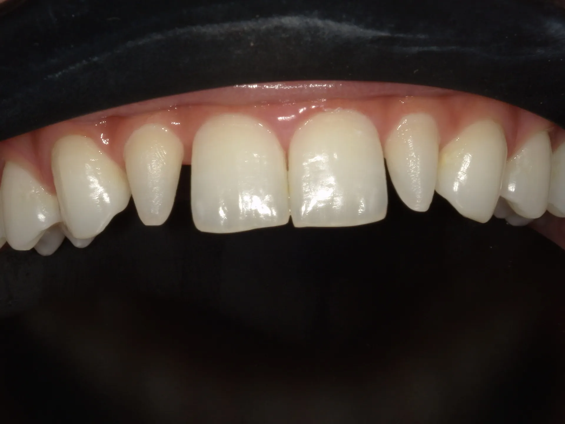 矯正 VS セラミック