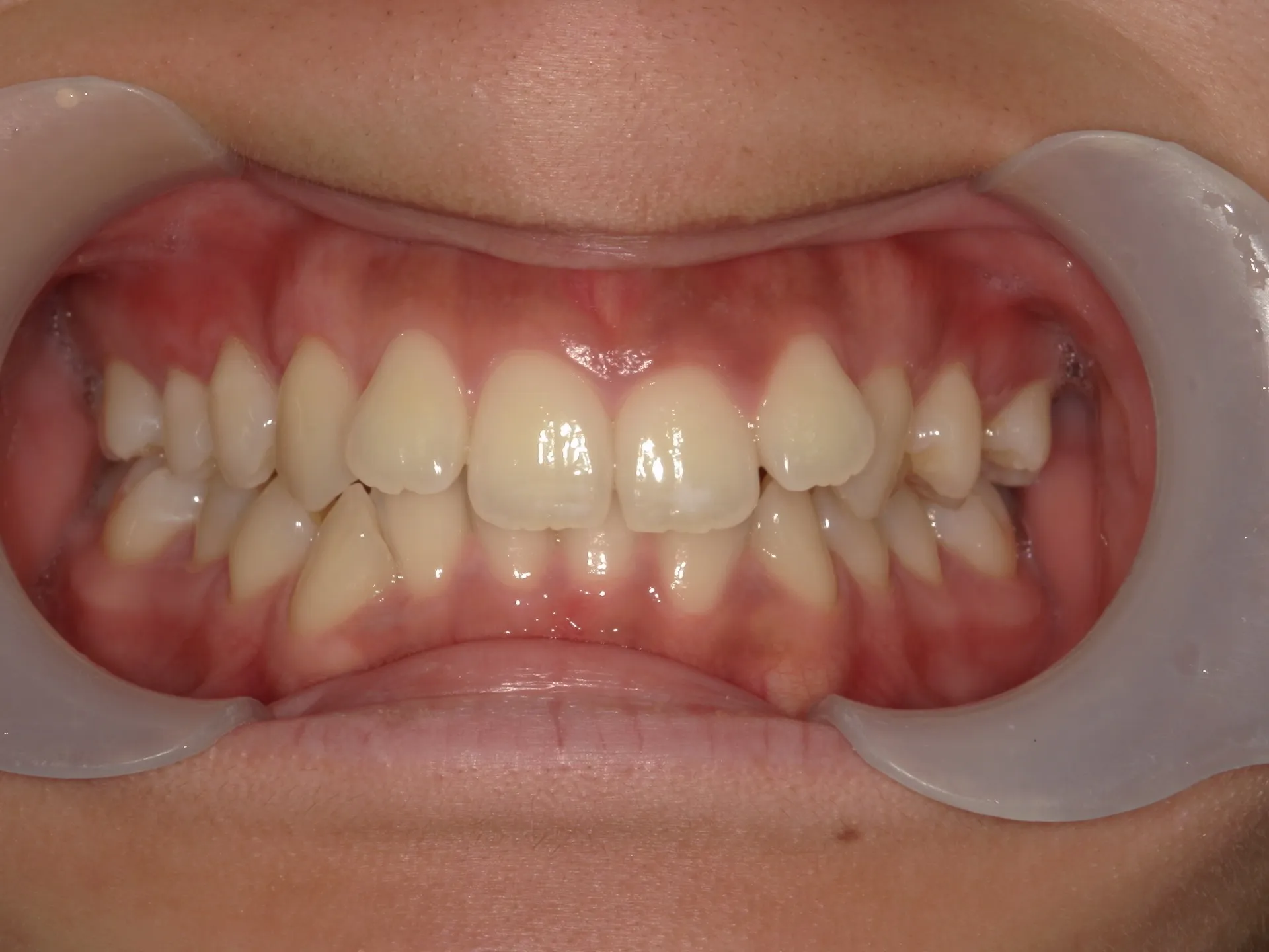 マウスピース矯正で1年間術前と術後