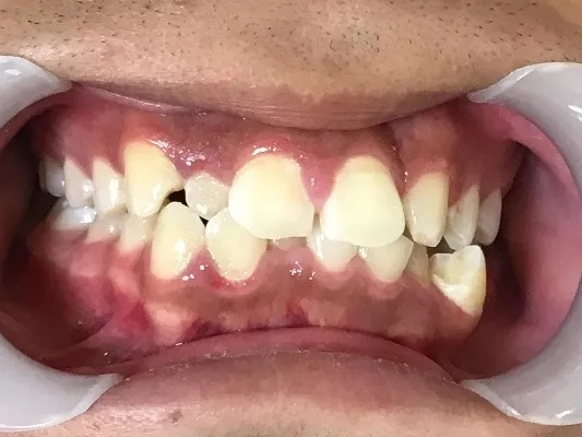 他院さんから引継いだインビザライン治療の患者様