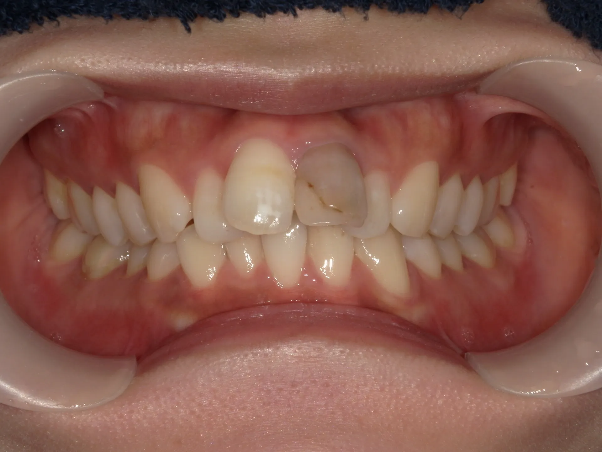大きく変わる前歯の傾斜(歯並び)