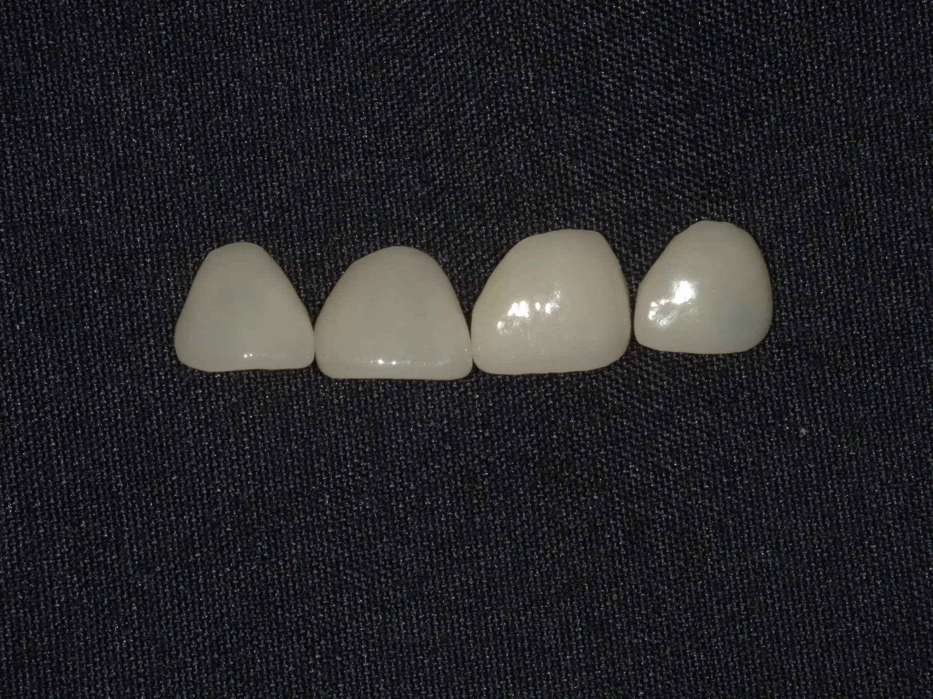 前歯の隙間をどう治す??