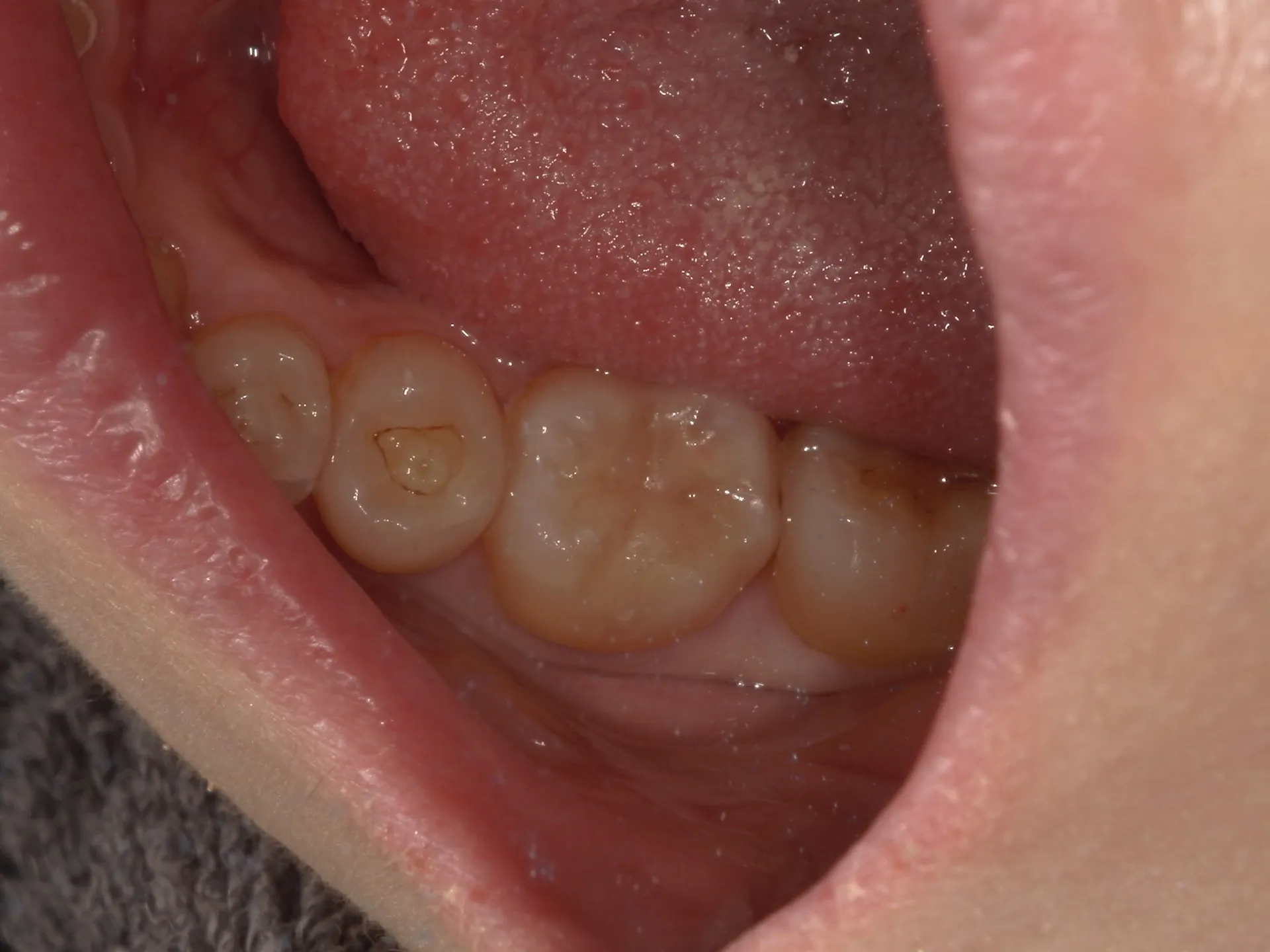 保険診療で即日治す白い詰め物🦷