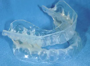 睡眠時無呼吸症候群のマウスピース