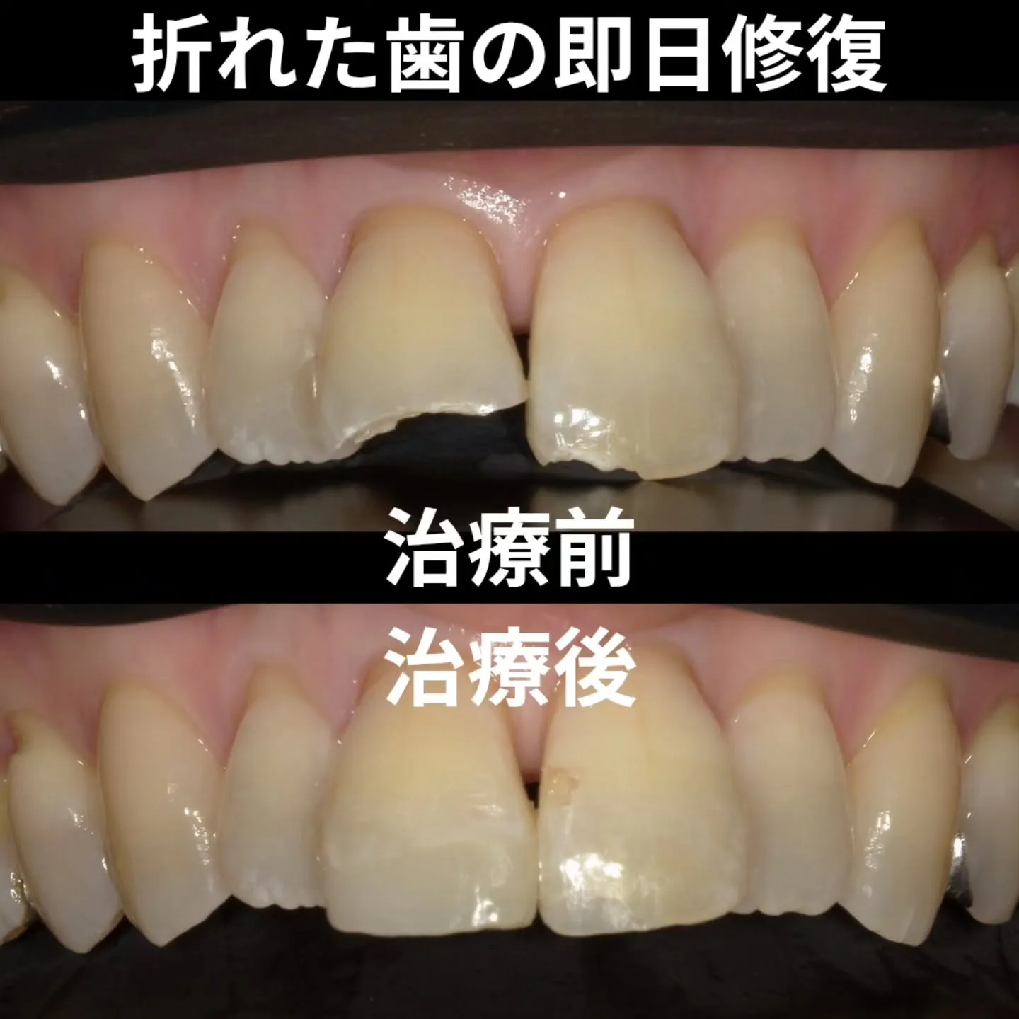 折れた歯の即日修復
