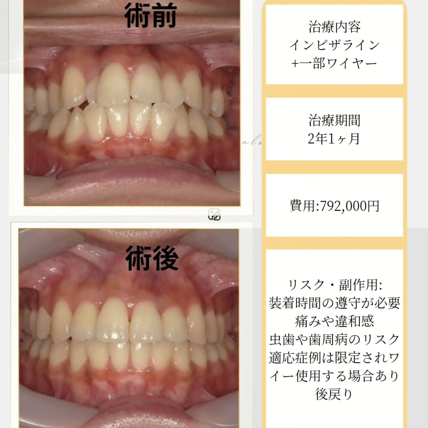【歯並びのお悩み、すっきり解決✨ インビザライン症例】